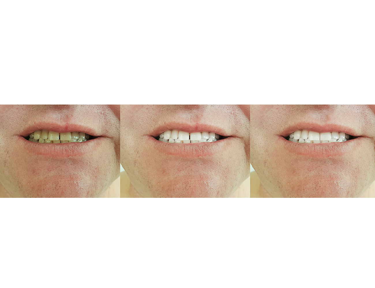 Full Mouth Implants Result